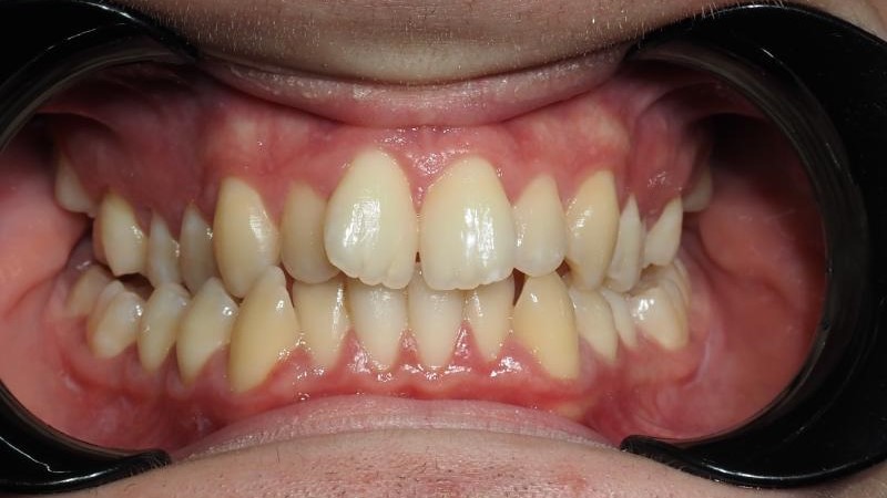 Mateusz przed leczeniem